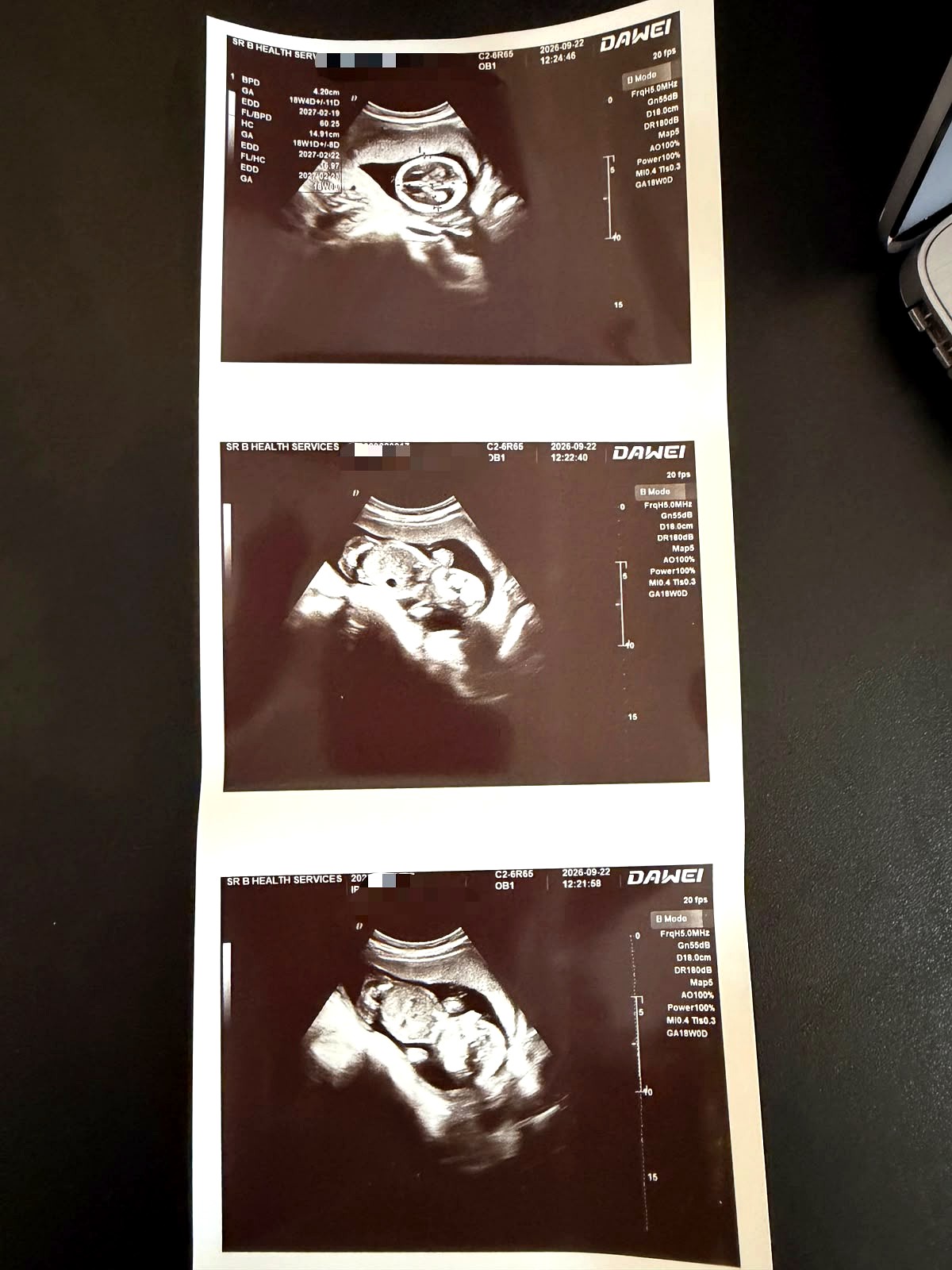 Printed strip of three 18-week pregnancy ultrasound images from a scan at SisterB Health Services